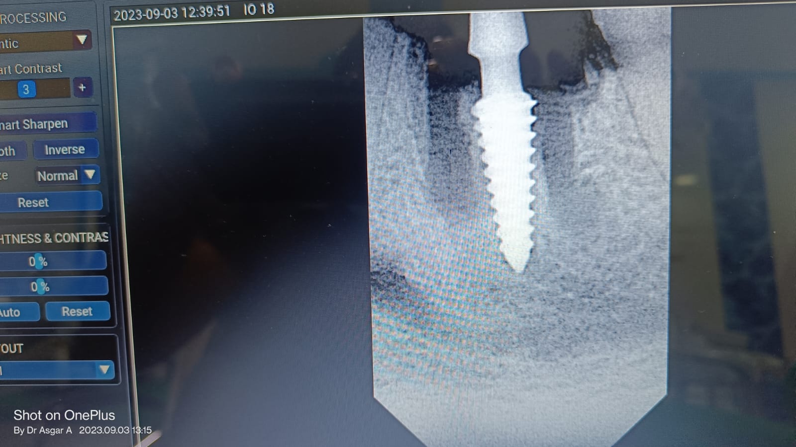 Dental implant before treatment